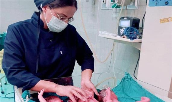 تولد 3 قلوها از مادر 24 ساله در رفسنجان